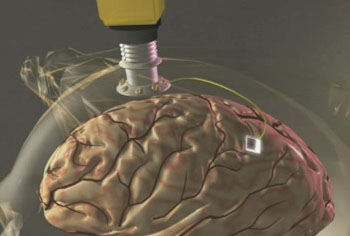 BrainGate Neural Interface System 